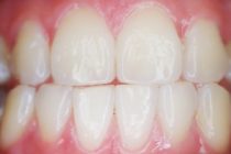 teeth-887338_1280